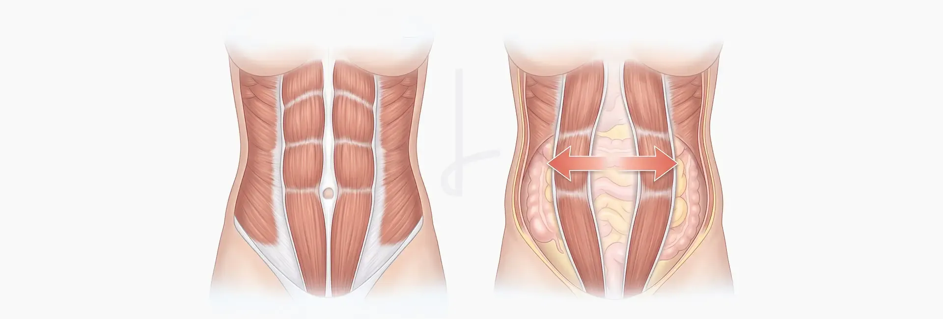 Diástase abdominal: o que é, causas e tratamento