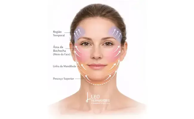 Diagrama das áreas tratadas no mini lifting facial: região temporal, bochecha, linha da mandíbula e pescoço superior